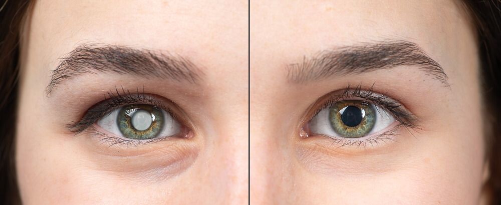 A picture of a girl who has cataracts.